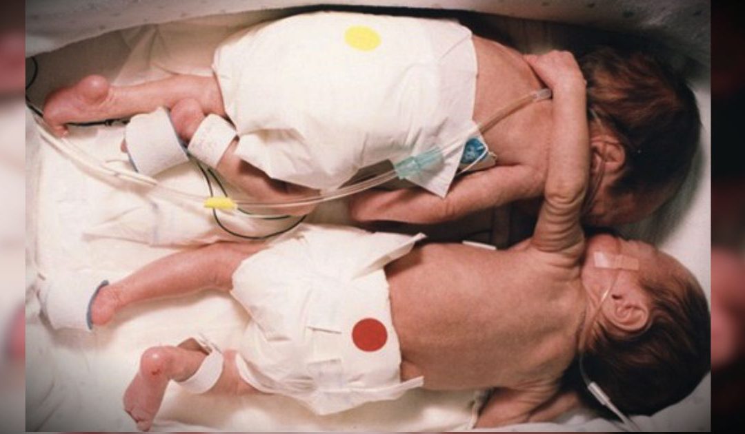 Hace 20 Años Estas Dos Gemelas Hicieron Historia Con Un Milagroso Abrazo –WOW!